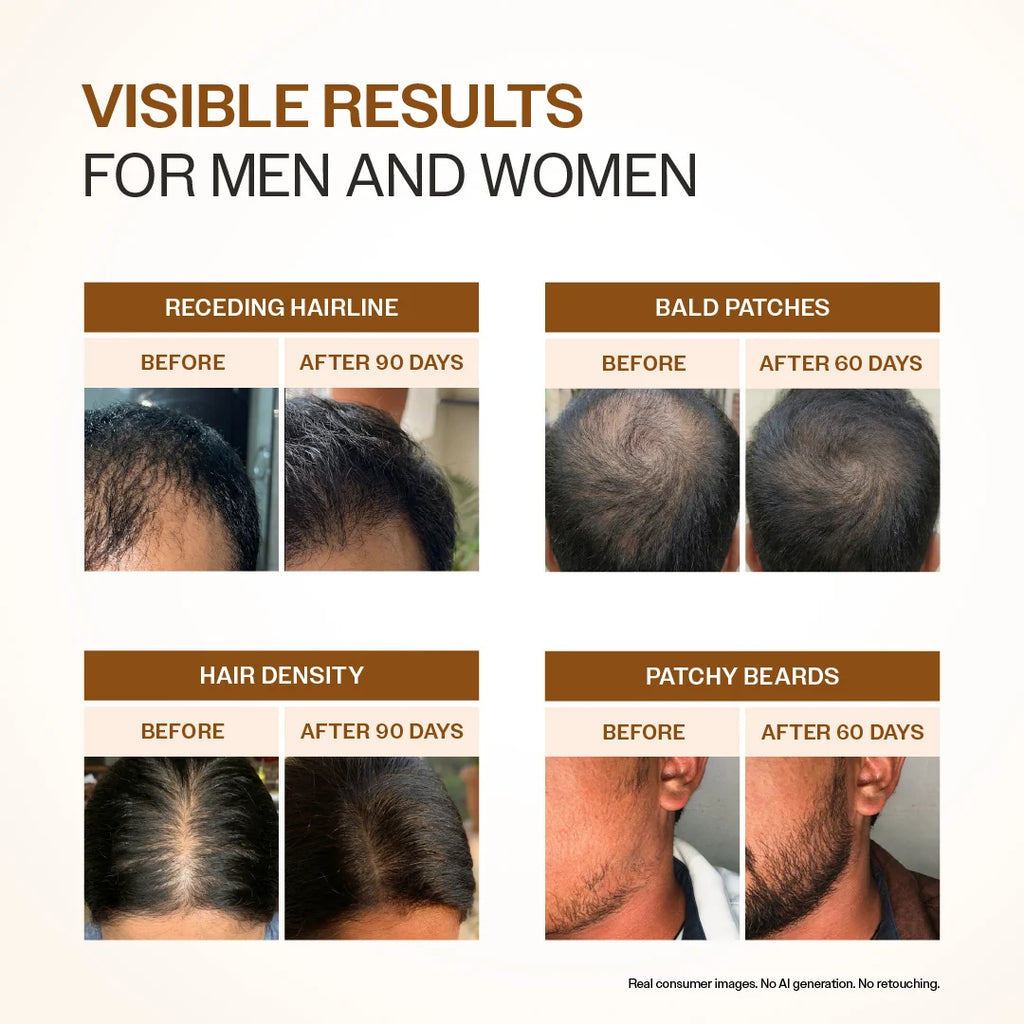 Advanced Hair Growth Serum With 3% Redensyl, 4% Anagain, & 1% Capilia Longa - 30 ml
