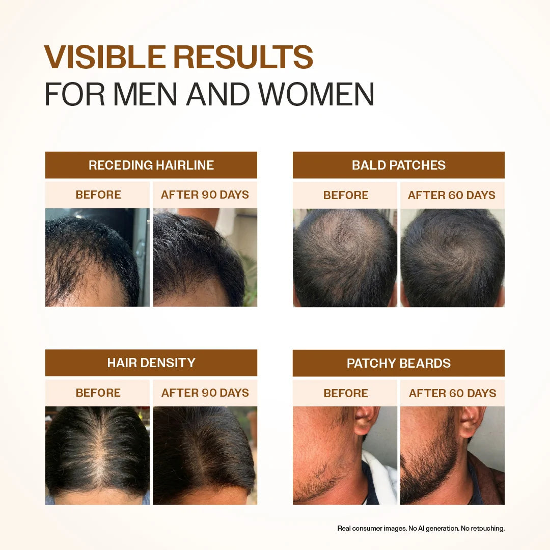 Advanced Hair Growth Serum With 3% Redensyl, 4% Anagain, & 1% Capilia Longa - 30 ml